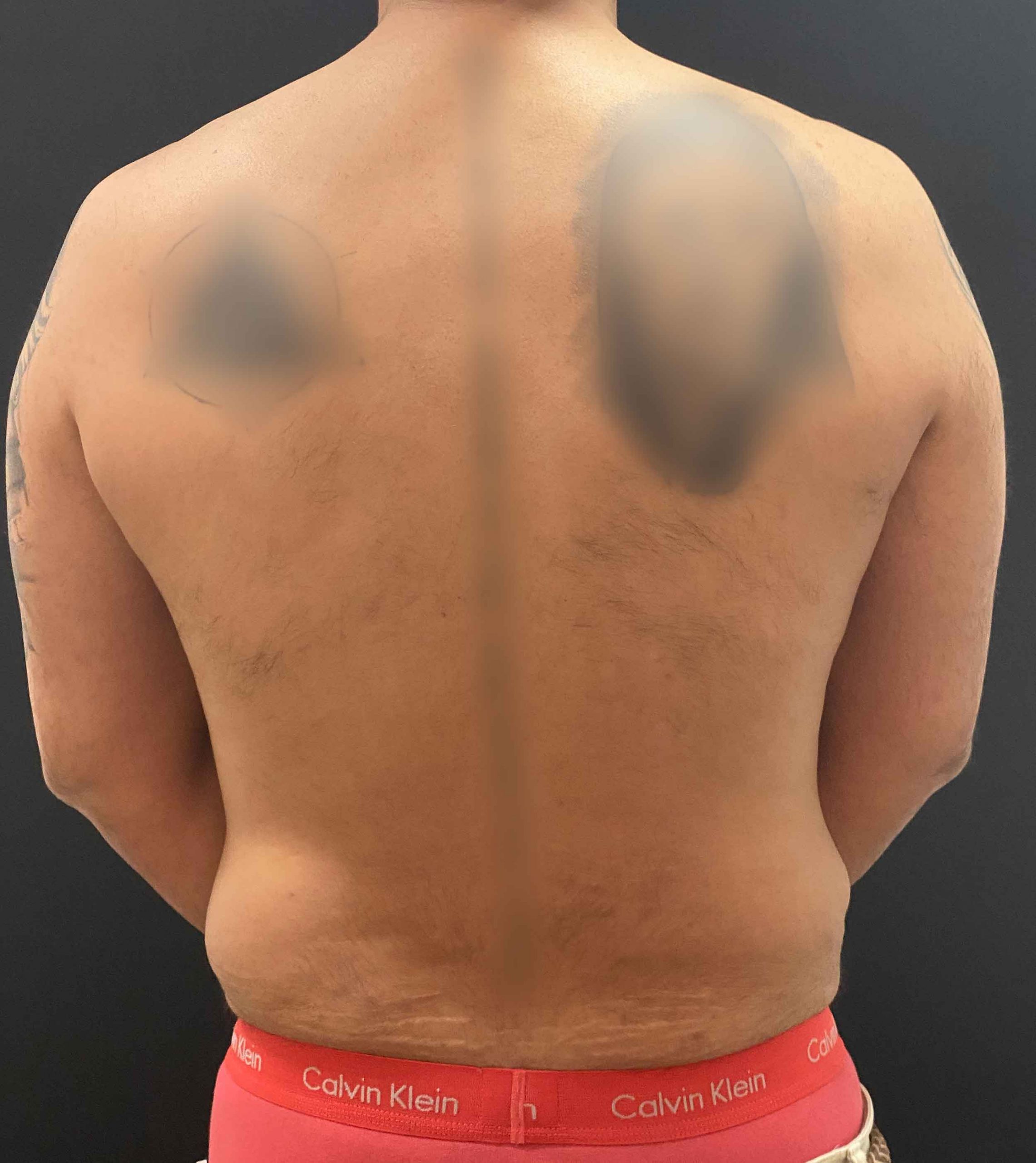 Liposucción espalda antes