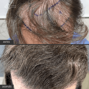 Injerto Capilar Horizon Capilar 2