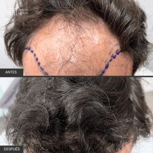 Injerto Capilar Horizon Capilar 3