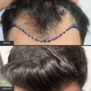 Injerto Capilar Horizon Capilar