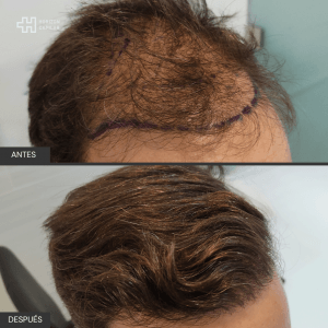 Injerto Capilar Horizon Capilar 6