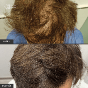 Injerto Capilar Horizon Capilar 5