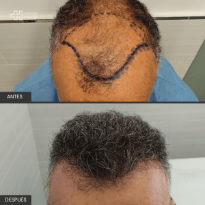 Injerto Capilar Horizon Capilar 4