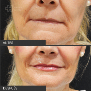 Antes y después landing aumento de labios (1)