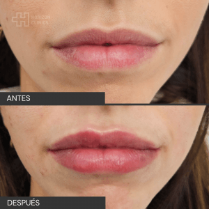 Antes y después landing hidratacion de labios (2)