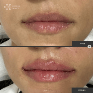 aumento-de-labios-horizon-clinics.png