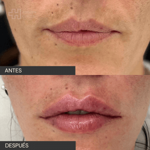 Antes y después landing aumento de labios (2)