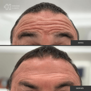 Antes y dspués botox (1)