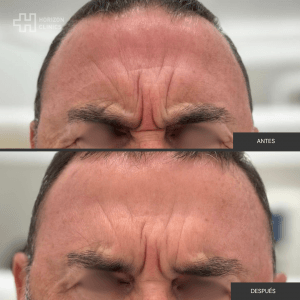 Antes y dspués botox (2)
