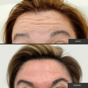 Copia de Antes y dspués botox