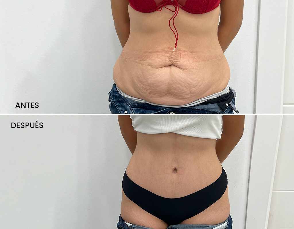 Antes y después-Abdominoplastia3