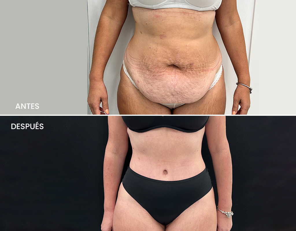 Antes y después-Abdominoplastia1