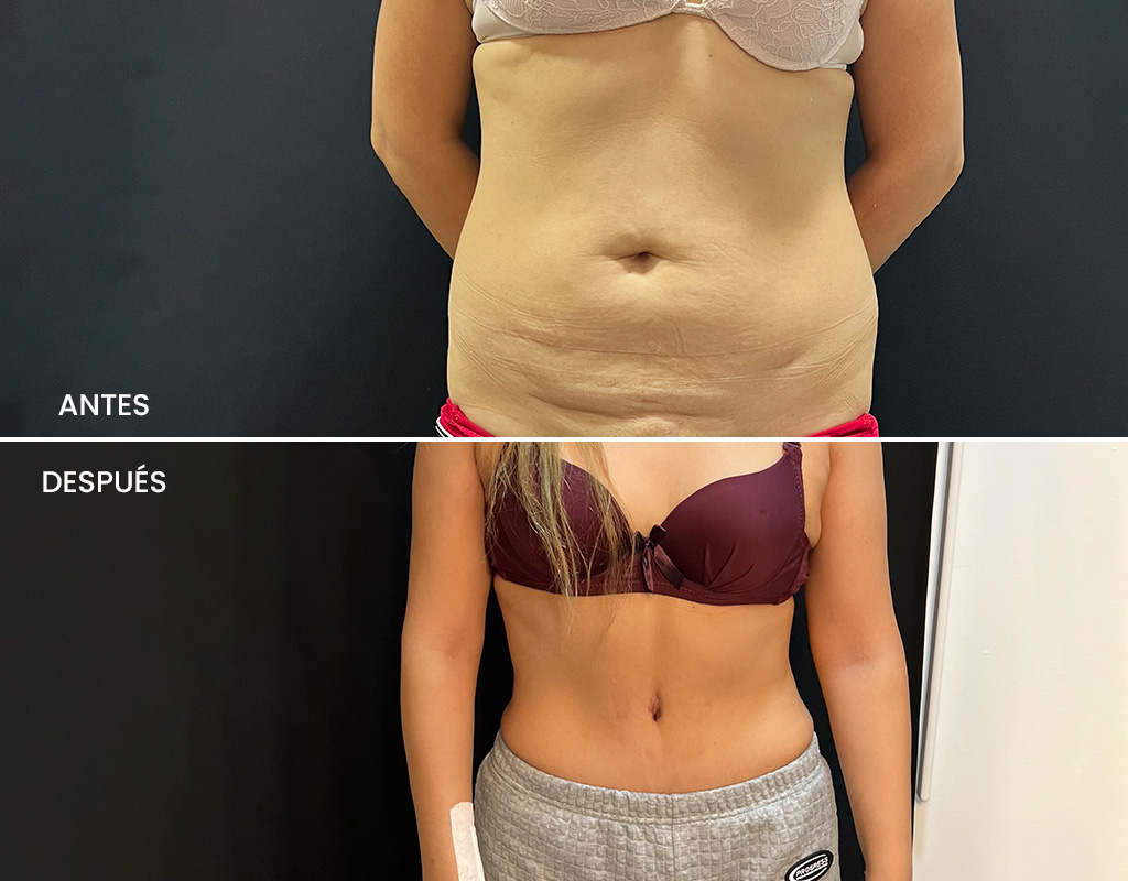 Antes y después-Abdominoplastia2