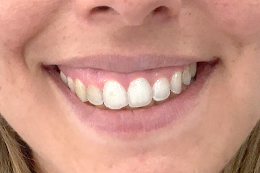 antes-sonrisa-gingival-celia