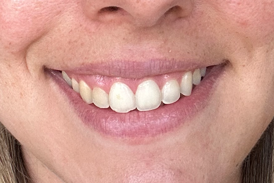 despues-sonrisa-gingival-celia