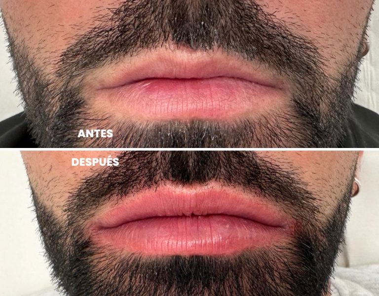 AYD-aumento labios masculino