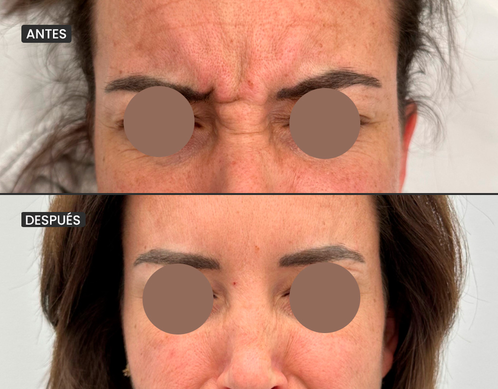 AyD_1024x800_botoxentrecejo_1