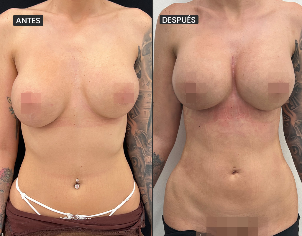 AyD_liposuccion1
