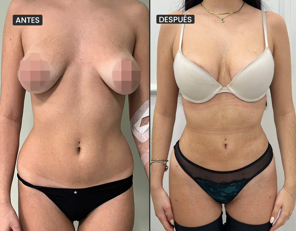 AyD_liposuccion2
